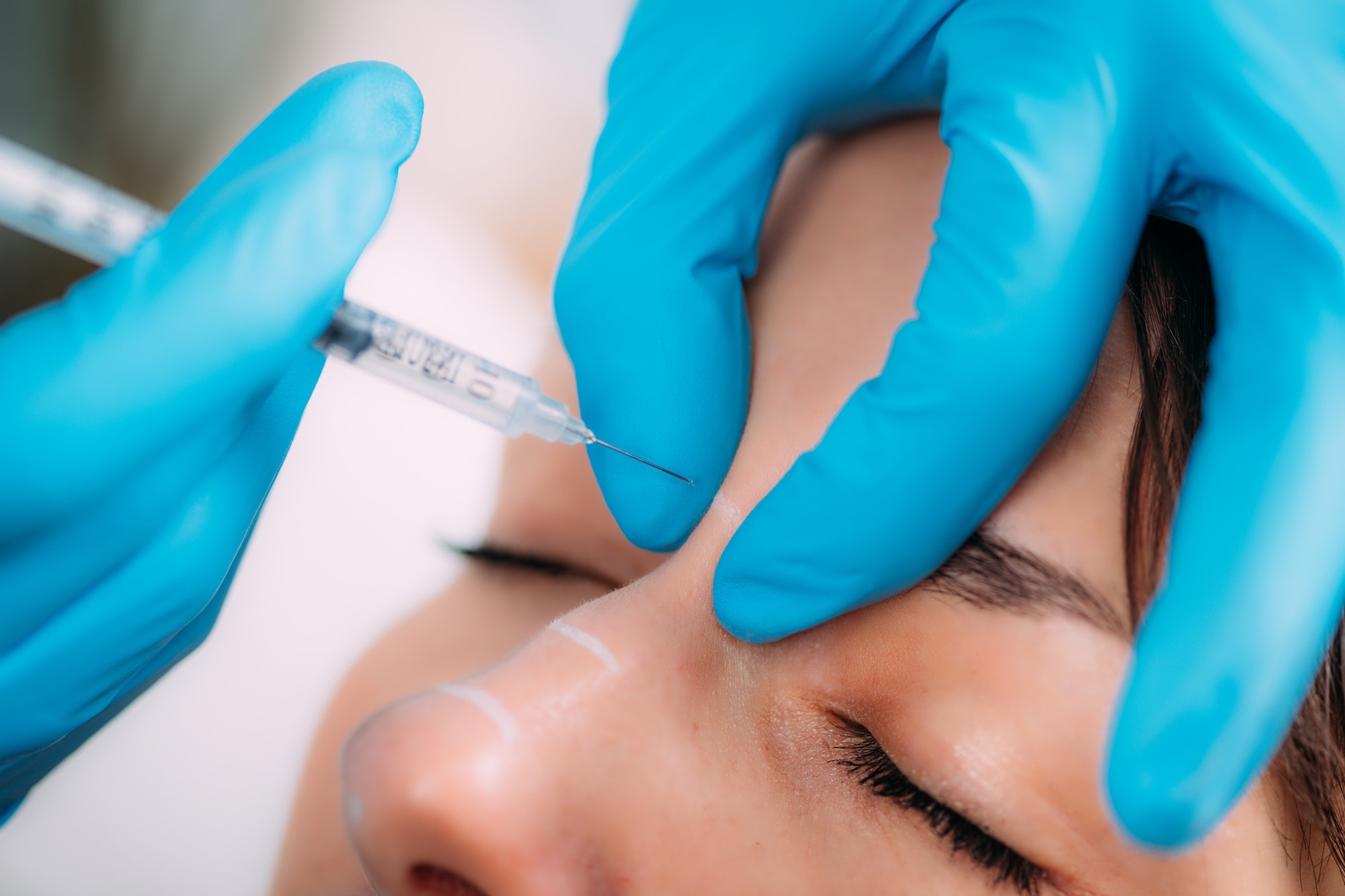 Dermal Filler for Nose Bridge Treatment.