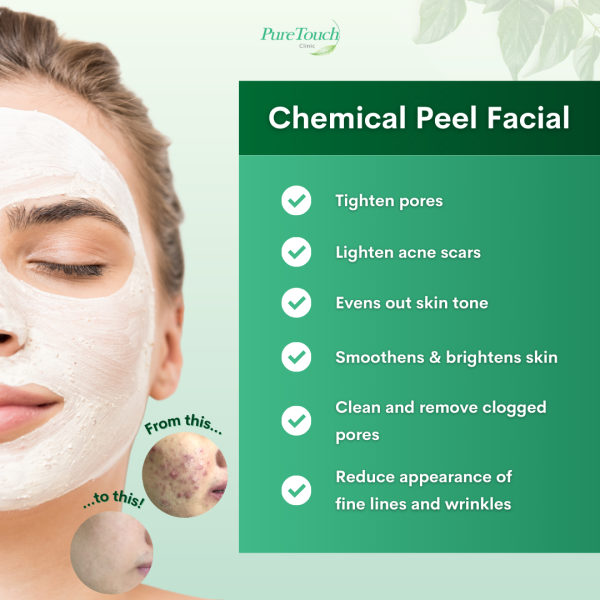 Chemical Peel Facial Features Chemical Peel Facial Features
