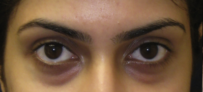 dark eye circles