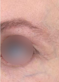 periorabital veins