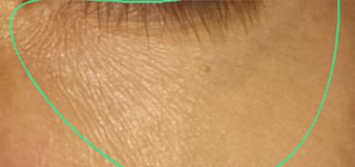 under-eye-wrinkles