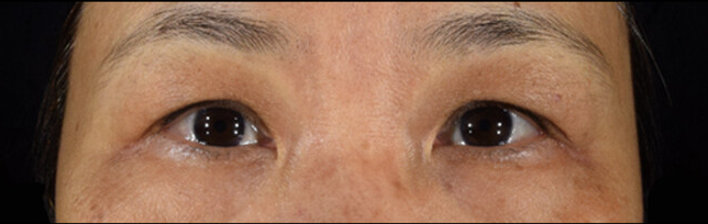 women undereye thin