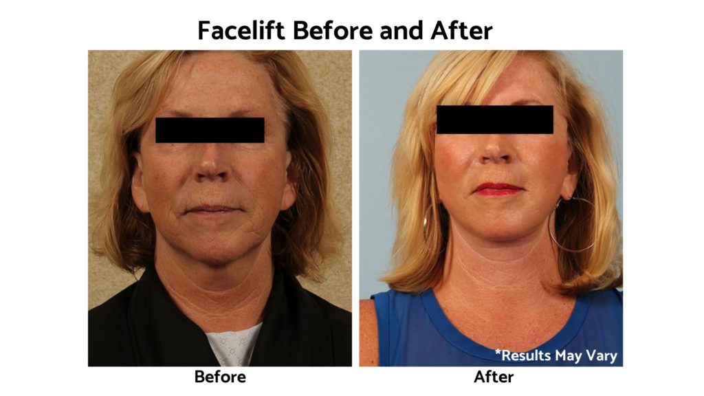 before vs after liquid facelift