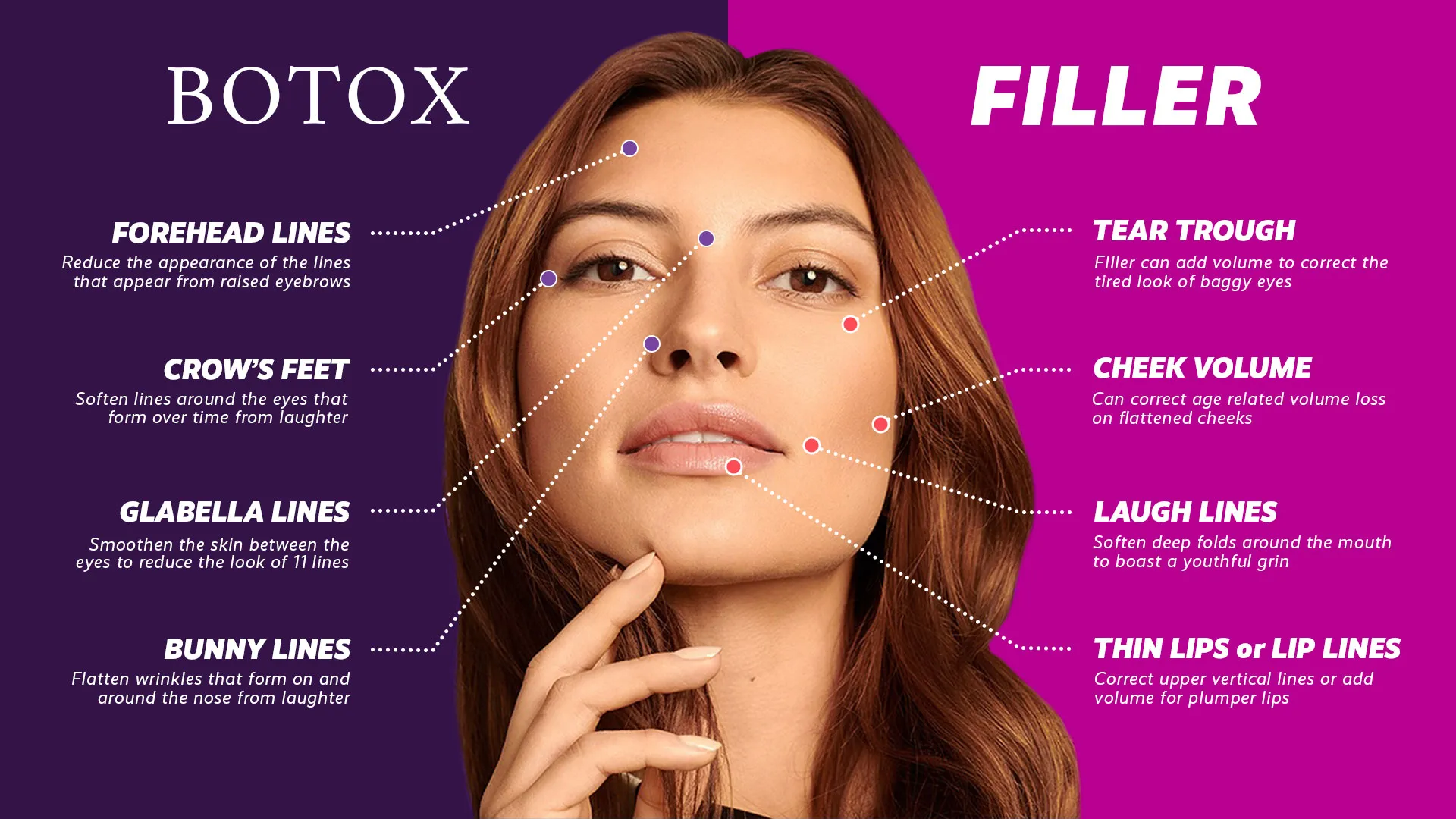 botox or filler